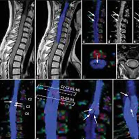mri lumbar spine with tractography